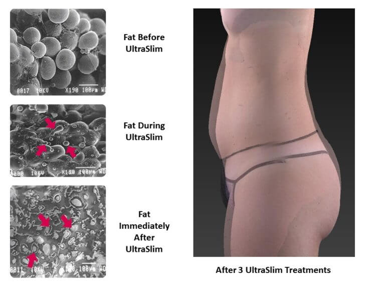 Before and after ultraslim