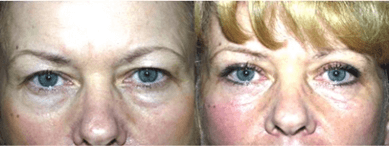 Before and after blepharoplasty images