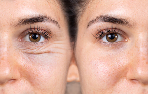 Before and after blepharoplasty images