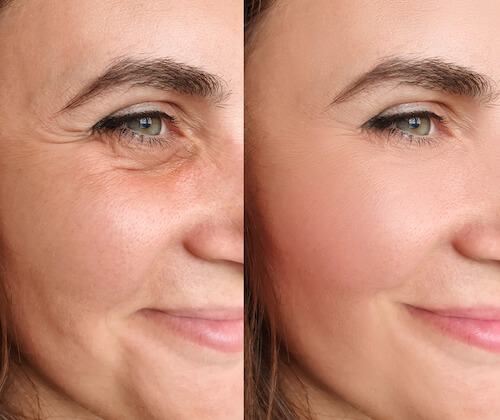 Before and after blepharoplasty images