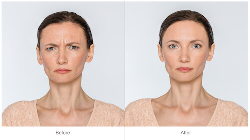 Before and after botox images