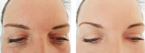 Before and after botox images