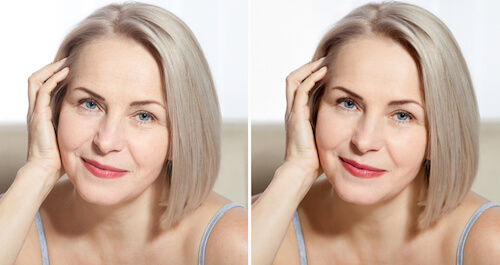 Before and after botox images