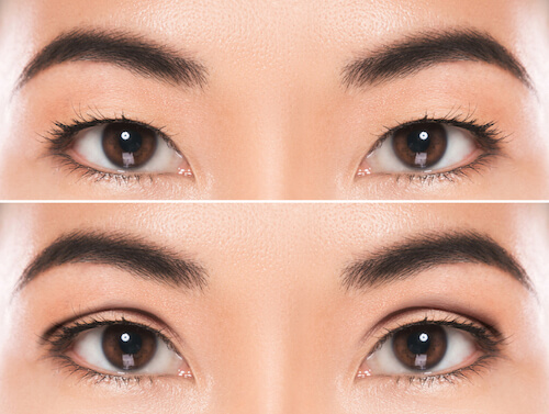 Before and after canthoplasty images