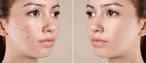 Before and after chemical peel images