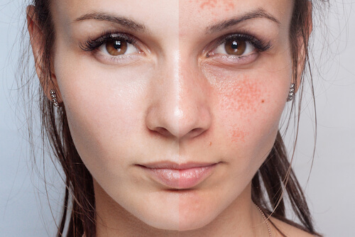 Before and after chemical peel images