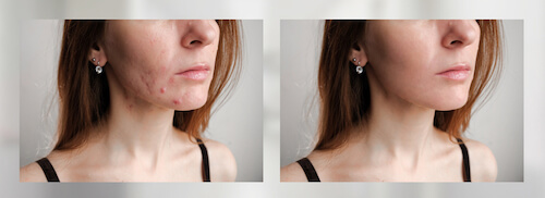 Before and after chemical peel images