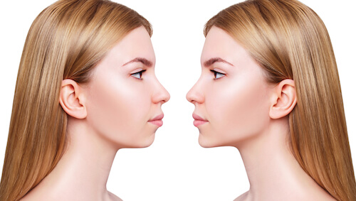 Before and after chin lift images