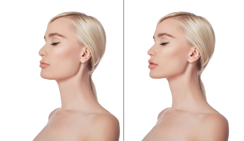 Before and after chin lift images