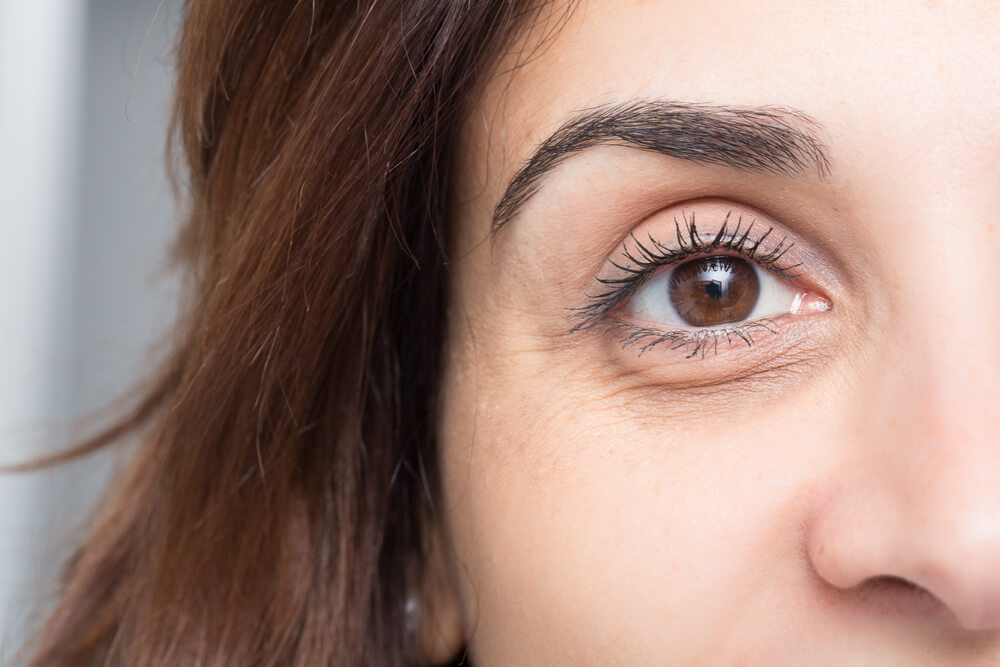 Dark circles under a woman's eye