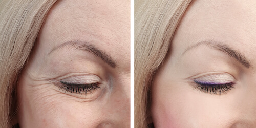 Before and after eyelid reconstruction images