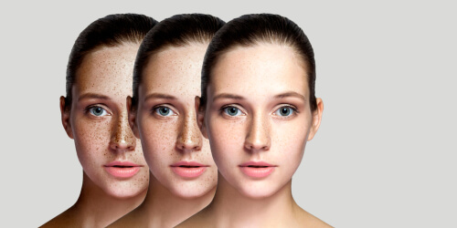 Three versions of same woman with improving skin