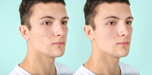 Before and after microneedling images