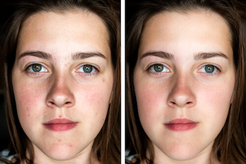 Before and after microneedling images