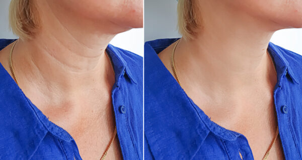 Woman neck wrinkles after treatment