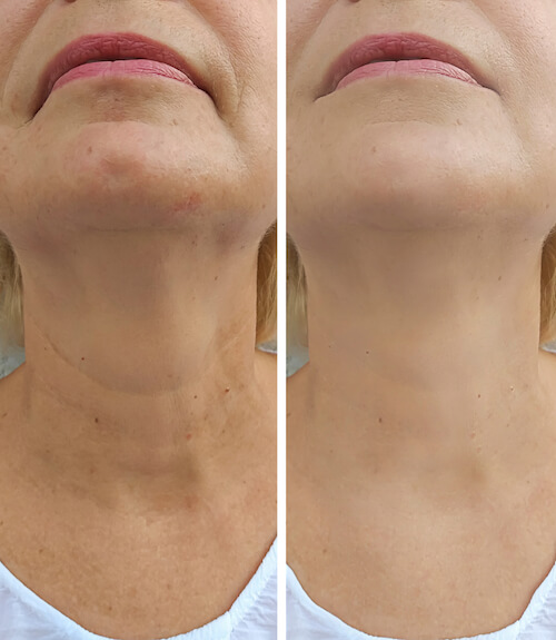 Before and after neck lift images