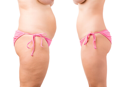 Before and after UltraSlim body images