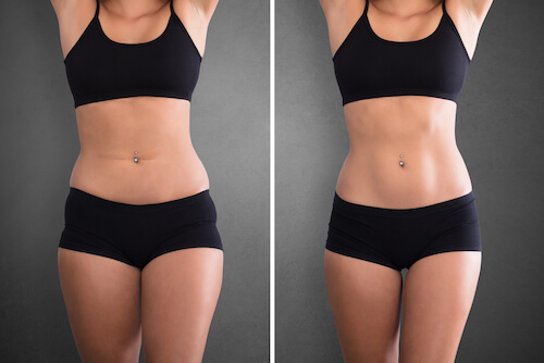 Before and after UltraSlim body images