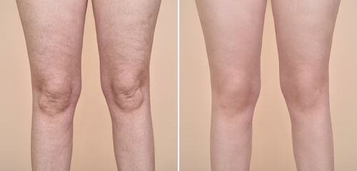 Before and after UltraSmooth body images